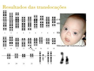 Resultados das translocações

- Câncer : as translocações agem diretamente na manutenção celular,
  exemplo: Leucemia Mielóide Aguda, Sarcoma de Ewing


- Infertilidade : Quando um membro apresenta gametas balanceados
   portadores


- Síndrome de Down : em 5% dos casos é resultado de translocação
 