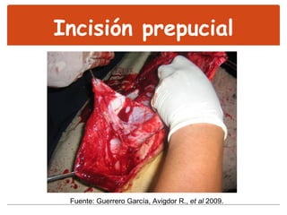 Incisión prepucial Fuente: Guerrero García, Avigdor R.,  et al  2009. 