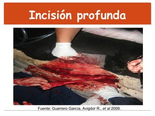 Incisión profunda Fuente: Guerrero García, Avigdor R.,  et al  2009. 