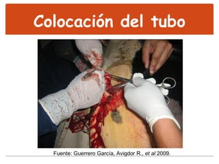 Colocación del tubo Fuente: Guerrero García, Avigdor R.,  et al  2009. 