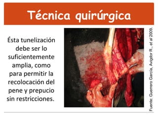 Técnica quirúrgica Ésta tunelización debe ser lo suficientemente amplia, como para permitir la recolocación del pene y prepucio sin restricciones.  Fuente: Guerrero García, Avigdor R.,  et al  2009. 