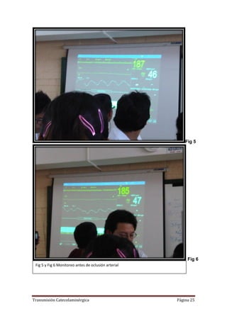 Transmisión Catecolaminérgica Página 25
Fig 5
Fig 6
Fig 5 y Fig 6 Monitoreo antes de oclusión arterial
 