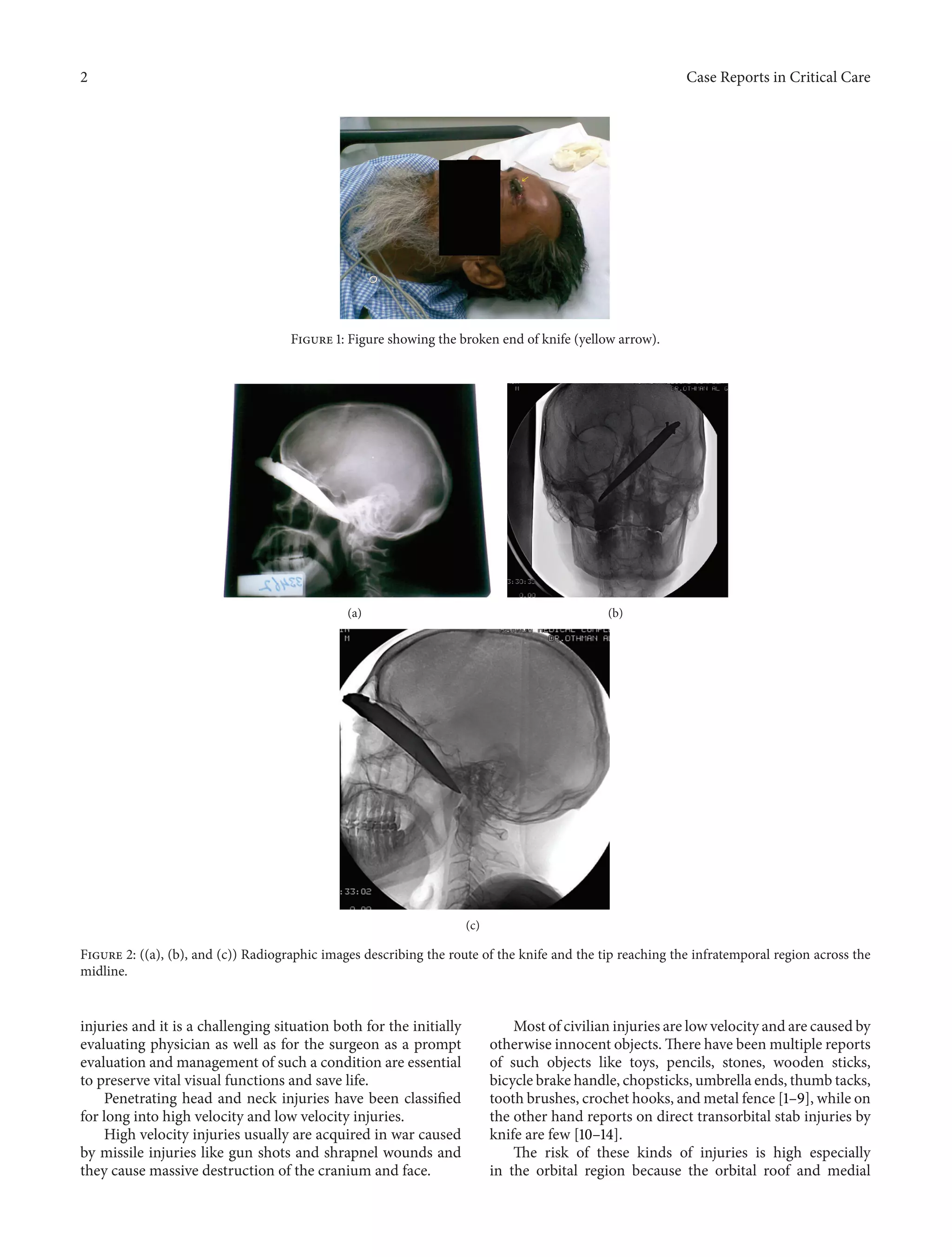 2 Case Reports in Critical Care 
Figure 1: Figure showing the broken end of knife (yellow arrow). 
(a) (b) 
(c) 
Figure 2: ((a), (b), and (c)) Radiographic images describing the route of the knife and the tip reaching the infratemporal region across the 
midline. 
injuries and it is a challenging situation both for the initially 
evaluating physician as well as for the surgeon as a prompt 
evaluation and management of such a condition are essential 
to preserve vital visual functions and save life. 
Penetrating head and neck injuries have been classified 
for long into high velocity and low velocity injuries. 
High velocity injuries usually are acquired in war caused 
by missile injuries like gun shots and shrapnel wounds and 
they cause massive destruction of the craniumand face. 
Most of civilian injuries are low velocity and are caused by 
otherwise innocent objects.There have beenmultiple reports 
of such objects like toys, pencils, stones, wooden sticks, 
bicycle brake handle, chopsticks, umbrella ends, thumb tacks, 
tooth brushes, crochet hooks, andmetal fence [1–9], while on 
the other hand reports on direct transorbital stab injuries by 
knife are few [10–14]. 
The risk of these kinds of injuries is high especially 
in the orbital region because the orbital roof and medial 
 