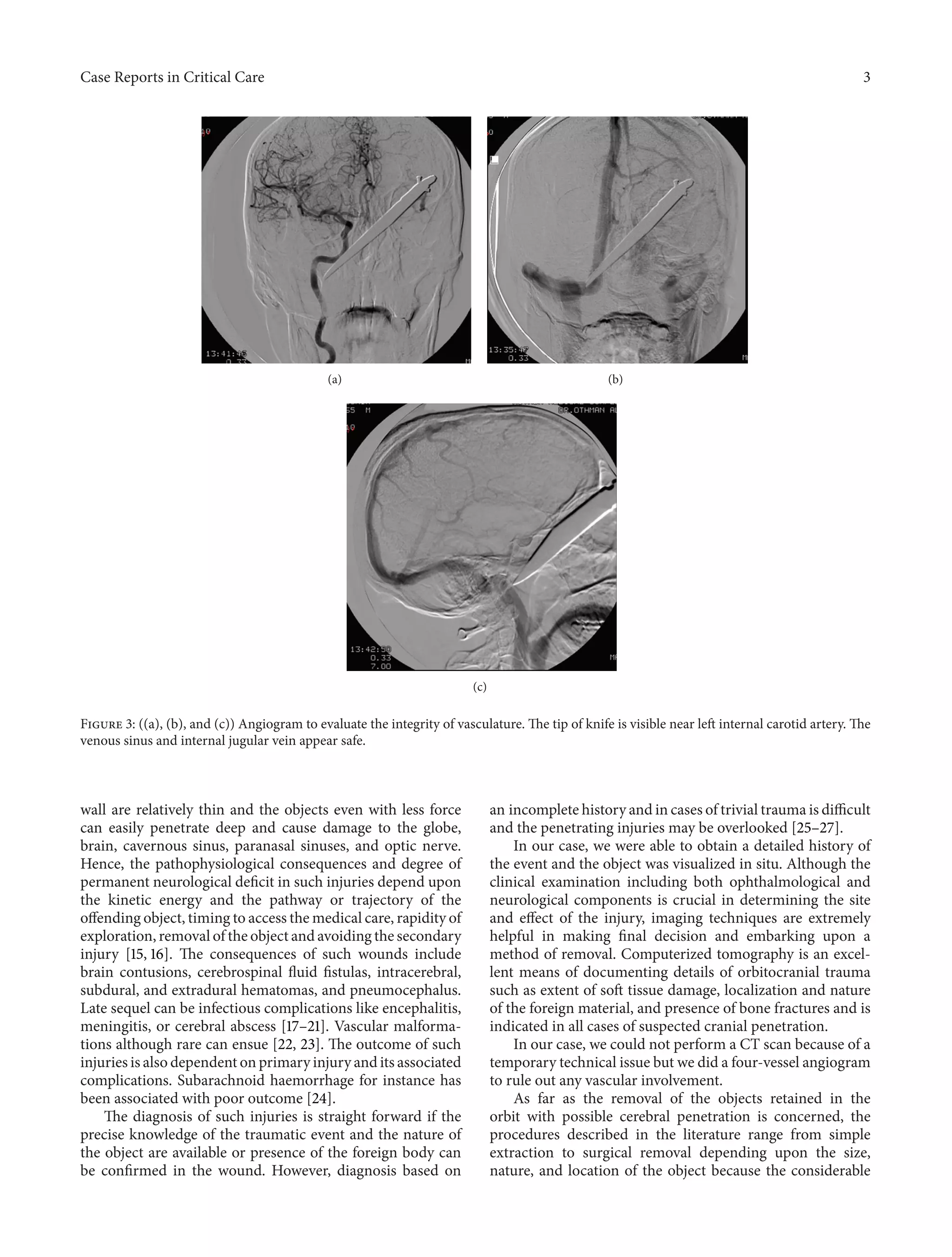 Case Reports in Critical Care 3 
(a) (b) 
(c) 
Figure 3: ((a), (b), and (c)) Angiogram to evaluate the integrity of vasculature.The tip of knife is visible near left internal carotid artery.The 
venous sinus and internal jugular vein appear safe. 
wall are relatively thin and the objects even with less force 
can easily penetrate deep and cause damage to the globe, 
brain, cavernous sinus, paranasal sinuses, and optic nerve. 
Hence, the pathophysiological consequences and degree of 
permanent neurological deficit in such injuries depend upon 
the kinetic energy and the pathway or trajectory of the 
offending object, timing to access themedical care, rapidity of 
exploration, removal of the object and avoiding the secondary 
injury [15, 16]. The consequences of such wounds include 
brain contusions, cerebrospinal fluid fistulas, intracerebral, 
subdural, and extradural hematomas, and pneumocephalus. 
Late sequel can be infectious complications like encephalitis, 
meningitis, or cerebral abscess [17–21]. Vascular malforma-tions 
although rare can ensue [22, 23]. The outcome of such 
injuries is also dependent on primary injury and its associated 
complications. Subarachnoid haemorrhage for instance has 
been associated with poor outcome [24]. 
The diagnosis of such injuries is straight forward if the 
precise knowledge of the traumatic event and the nature of 
the object are available or presence of the foreign body can 
be confirmed in the wound. However, diagnosis based on 
an incomplete history and in cases of trivial trauma is difficult 
and the penetrating injuries may be overlooked [25–27]. 
In our case, we were able to obtain a detailed history of 
the event and the object was visualized in situ. Although the 
clinical examination including both ophthalmological and 
neurological components is crucial in determining the site 
and effect of the injury, imaging techniques are extremely 
helpful in making final decision and embarking upon a 
method of removal. Computerized tomography is an excel-lent 
means of documenting details of orbitocranial trauma 
such as extent of soft tissue damage, localization and nature 
of the foreign material, and presence of bone fractures and is 
indicated in all cases of suspected cranial penetration. 
In our case, we could not perform a CT scan because of a 
temporary technical issue butwe did a four-vessel angiogram 
to rule out any vascular involvement. 
As far as the removal of the objects retained in the 
orbit with possible cerebral penetration is concerned, the 
procedures described in the literature range from simple 
extraction to surgical removal depending upon the size, 
nature, and location of the object because the considerable 
 