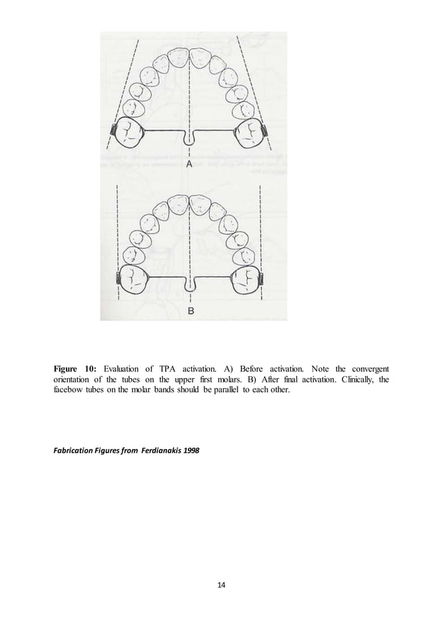 Transpalatal, nance, lingual arch, quadhelix appliances for orthodontists by almuzian PDF