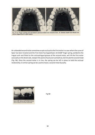 Transpalatal, nance, lingual arch, quadhelix appliances for orthodontists by almuzian