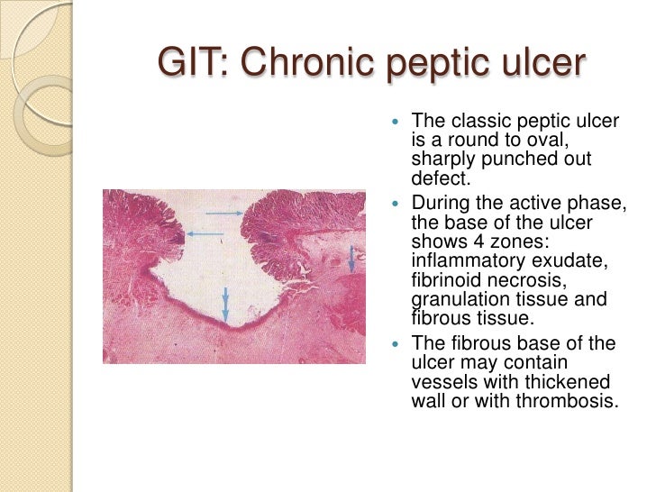 pathophysiology of peptic ulcer pathophysiology of peptic ulcer