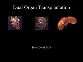 Dual Organ Transplantation Tejas Desai, MD 