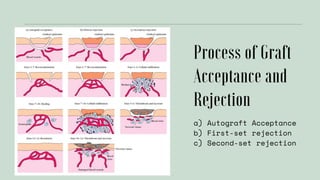 a) Autograft Acceptance
b) First-set rejection
c) Second-set rejection
 
