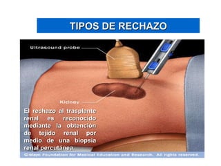 TIPOS DE RECHAZO El rechazo al trasplante renal es reconocido mediante la obtención de tejido renal por medio de una biopsia renal percutánea. 