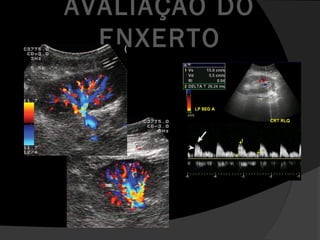 AVALIAÇÃO DO
ENXERTO
 