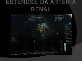 ESTENOSE DA ARTÉRIA
RENAL
 