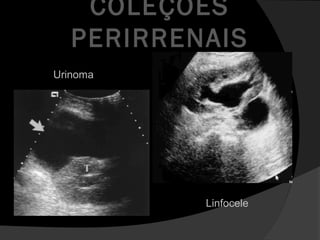 COLEÇÕES
PERIRRENAIS
Urinoma
Linfocele
 