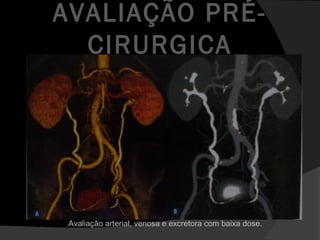 Avaliação arterial, venosa e excretora com baixa dose.
AVALIAÇÃO PRÉ-
CIRURGICA
 