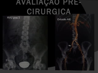 RVU grau 2
AVALIAÇÃO PRÉ-
CIRURGICA
Oclusão AIE
 