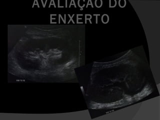 AVALIAÇÃO DO
ENXERTO
 