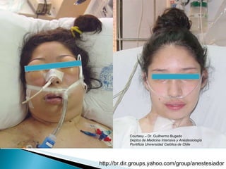 Courtesy – Dr. Guilhermo Bugedo Deptos de Medicina Intensiva y Anestesiología Pontificia Universidad Católica de Chile 
