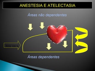 ANESTESIA E ATELECTASIA FIO2 100 % 