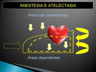 ANESTESIA E ATELECTASIA FIO2 100 % 