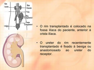 • O rim transplantado é colocado na
fossa ilíaca do paciente, anterior à
crista ilíaca.
• O ureter do rim recentemente
transplantado é fixado à bexiga ou
anastomosado
ao
ureter
do
receptor.

 