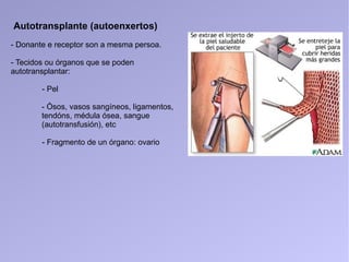 Autotransplante (autoenxertos)
- Donante e receptor son a mesma persoa.
- Tecidos ou órganos que se poden
autotransplantar:
- Pel
- Ósos, vasos sangíneos, ligamentos,
tendóns, médula ósea, sangue
(autotransfusión), etc
- Fragmento de un órgano: ovario
 