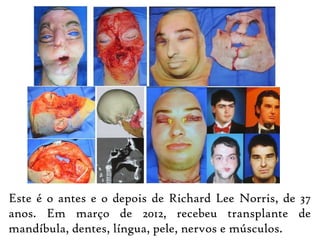 Este é o antes e o depois de Richard Lee Norris, de 37
anos. Em março de 2012, recebeu transplante de
mandíbula, dentes, língua, pele, nervos e músculos.
 