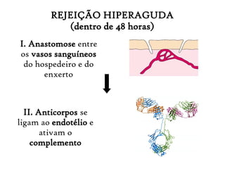 REJEIÇÃO HIPERAGUDA
(dentro de 48 horas)
I. Anastomose entre
os vasos sanguíneos
do hospedeiro e do
enxerto
II. Anticorpos se
ligam ao endotélio e
ativam o
complemento
 