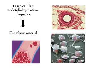 Lesão celular
endotelial que ativa
plaquetas
Trombose arterial
 