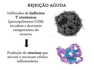 REJEIÇÃO AGUDA
Infiltrados de linfócitos
T citotóxicos
(principalmente CD8)
invadem e destroem
componentes do
enxerto
Produção de citocinas que
ativam e recrutam células
inflamatórias
 