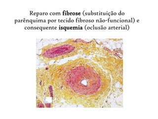 Reparo com fibrose (substituição do
parênquima por tecido fibroso não-funcional) e
consequente isquemia (oclusão arterial)
 