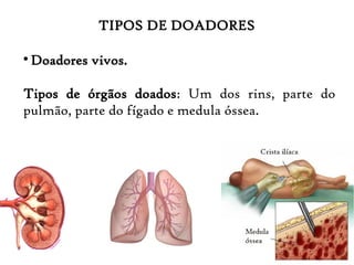 TIPOS DE DOADORES

Doadores vivos.
Tipos de órgãos doados: Um dos rins, parte do
pulmão, parte do fígado e medula óssea.
 