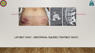 LAP BELT ONLY - ABDOMINAL INJURIES ("SEATBELT SIGN")
 