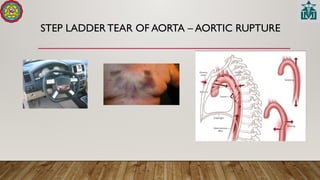 STEP LADDERTEAR OF AORTA – AORTIC RUPTURE
 