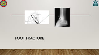 FOOT FRACTURE
 