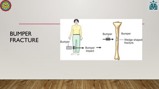 BUMPER
FRACTURE
 