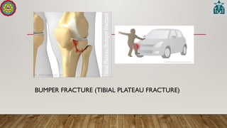 BUMPER FRACTURE (TIBIAL PLATEAU FRACTURE)
 