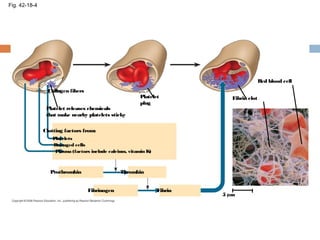 Collagen fibers
Platelet
plug
Platelet releases chemicals
that make nearby platelets sticky
Clotting factors from:
Platelets
Damaged cells
Plasma (factors include calcium, vitamin K)
Prothrombin Thrombin
Fibrinogen Fibrin
5 µm
Fibrin clot
Red blood cell
Fig. 42-18-4
 