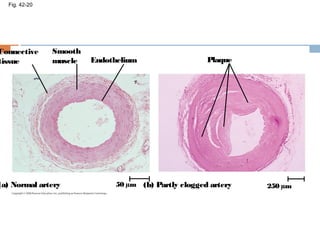 Fig. 42-20
Connective
tissue
Smooth
muscle Endothelium Plaque
(a) Normal artery (b) Partly clogged artery50 µm 250 µm
 