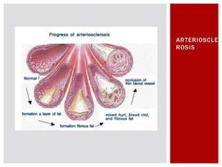 ARTERIOSCLE
ROSIS
 