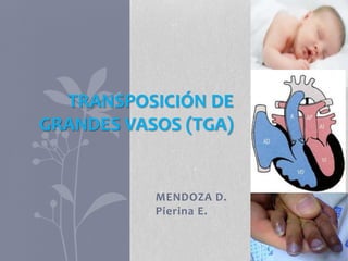 MENDOZA D.
Pierina E.
TRANSPOSICIÓN DE
GRANDES VASOS (TGA)
 
