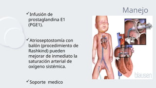 TRANSPOSICION DE GRANDES VASOS. CARDIOPATIAS EN PEDIATRIA | PPTX