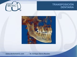 TRANSPOSICIÓN
DENTARIA
www.dentometric.com Dr. Enrique Sierra Rosales
 