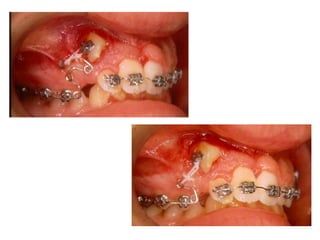 Transposição Total