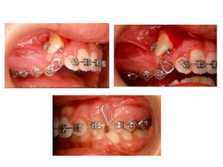 Transposição Total