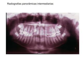 Transposição Total