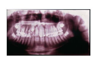 Transposição Total