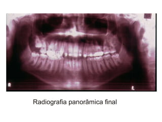 Transposição Total