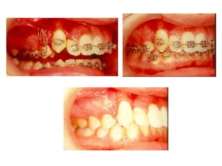 Transposição Total