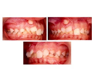 Transposição Total