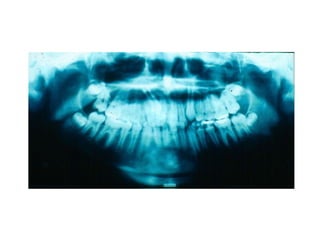 Transposição Total